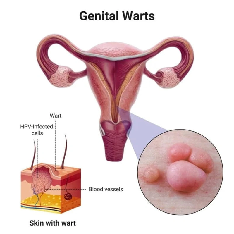 زگیل سرطانی (HPV پرخطر) چیست؟