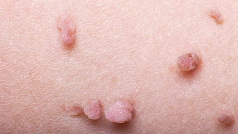 زگیل سرطانی (HPV پرخطر) چیست؟