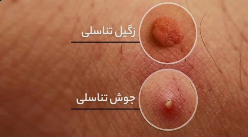 علائم خوب شدن و ریشه کن شدن زگیل تناسلی چیست؟ | کلینیک درمان اول