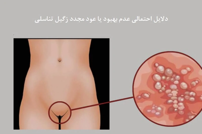 عود مجدد زگیل تناسلی