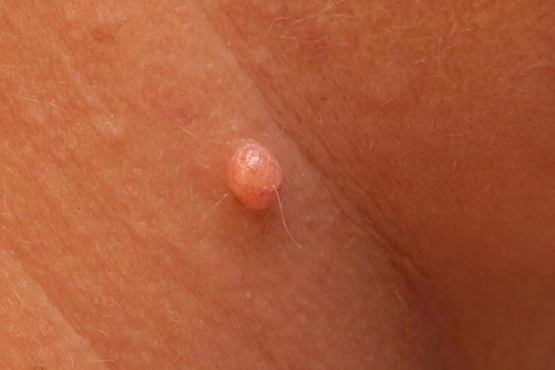 چه چیزی باعث عود زگیل تناسلی می شود؟