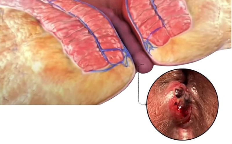 علائم بواسیر عفونی چیست؟ | کلینیک درمان اول
