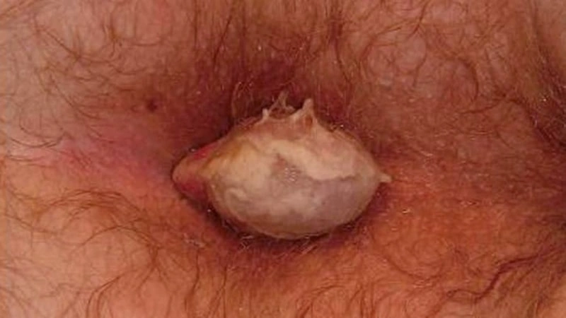 علائم بواسیر عفونی چیست؟