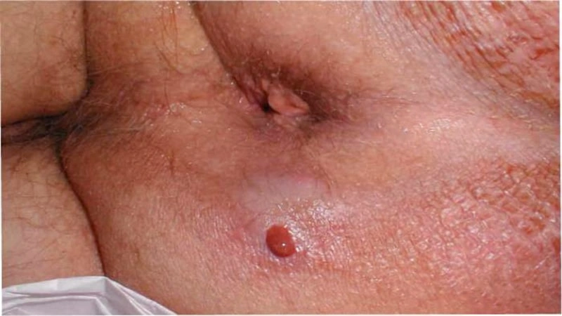 علائم بواسیر عفونی چیست؟