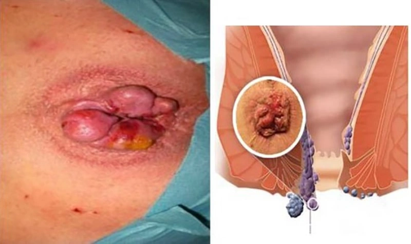 علائم بواسیر عفونی چیست؟