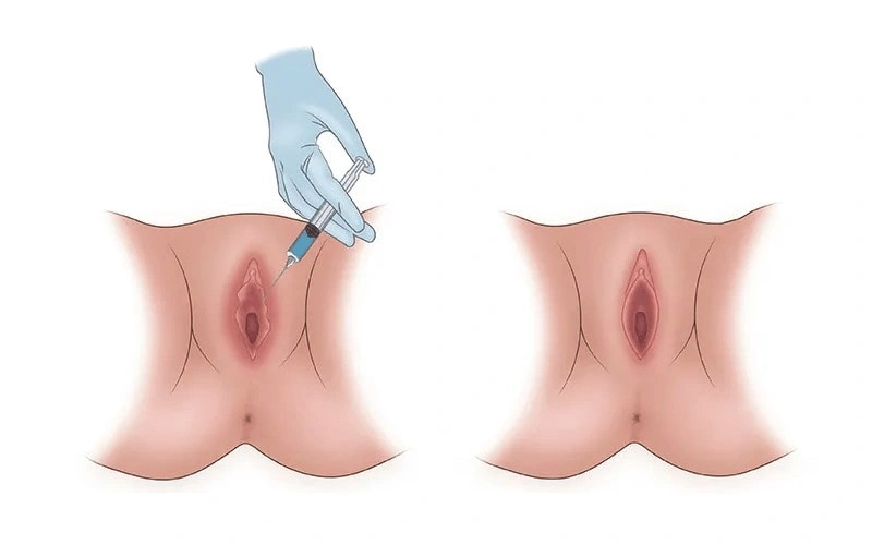 تزریق چربی و تزریق ژل در ناحیه بیکینی چه تفاوتی دارند؟
