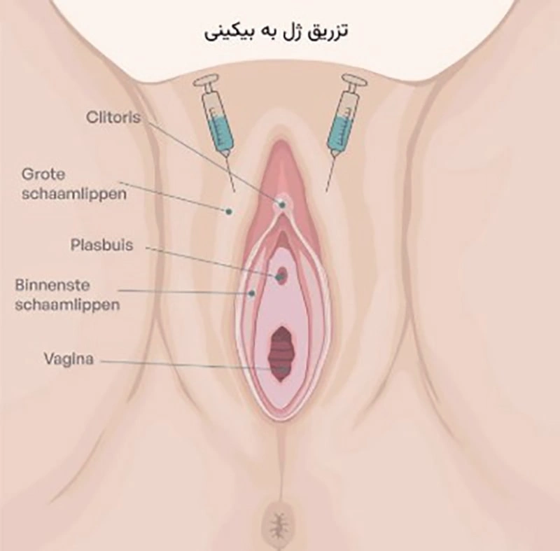 تزریق چربی و تزریق ژل در ناحیه بیکینی چه تفاوتی دارند؟