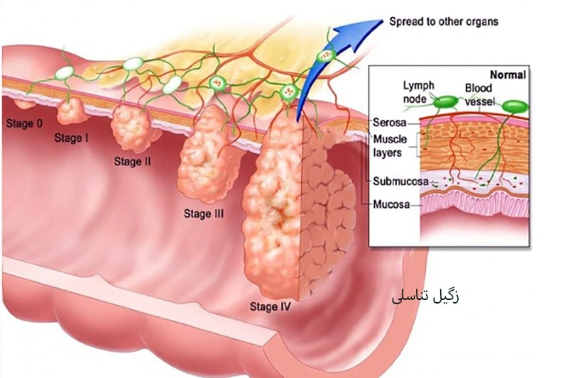 زگیل تناسلی