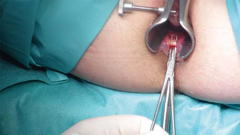 معایب و مزایای لیزر شقاق مقعدی یا فیشر کدامند؟