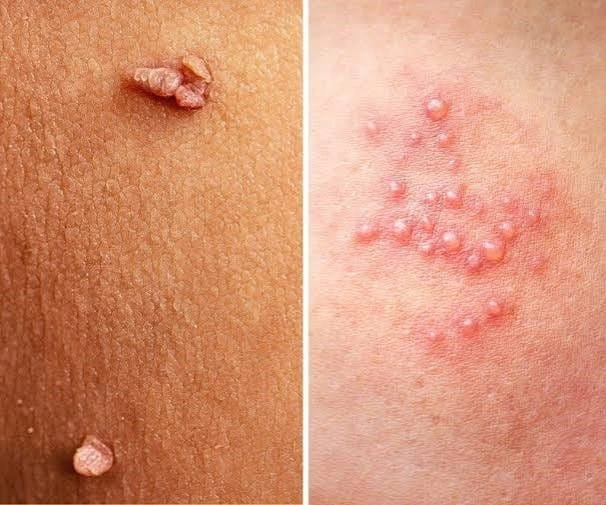تفاوت تبخال با زگیل تناسلی چیست؟