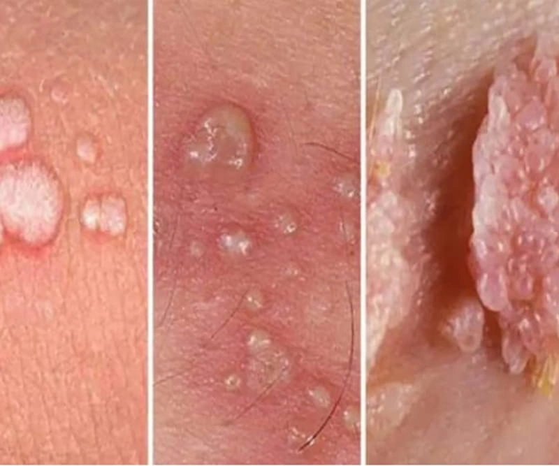 تفاوت تبخال با زگیل تناسلی چیست؟
