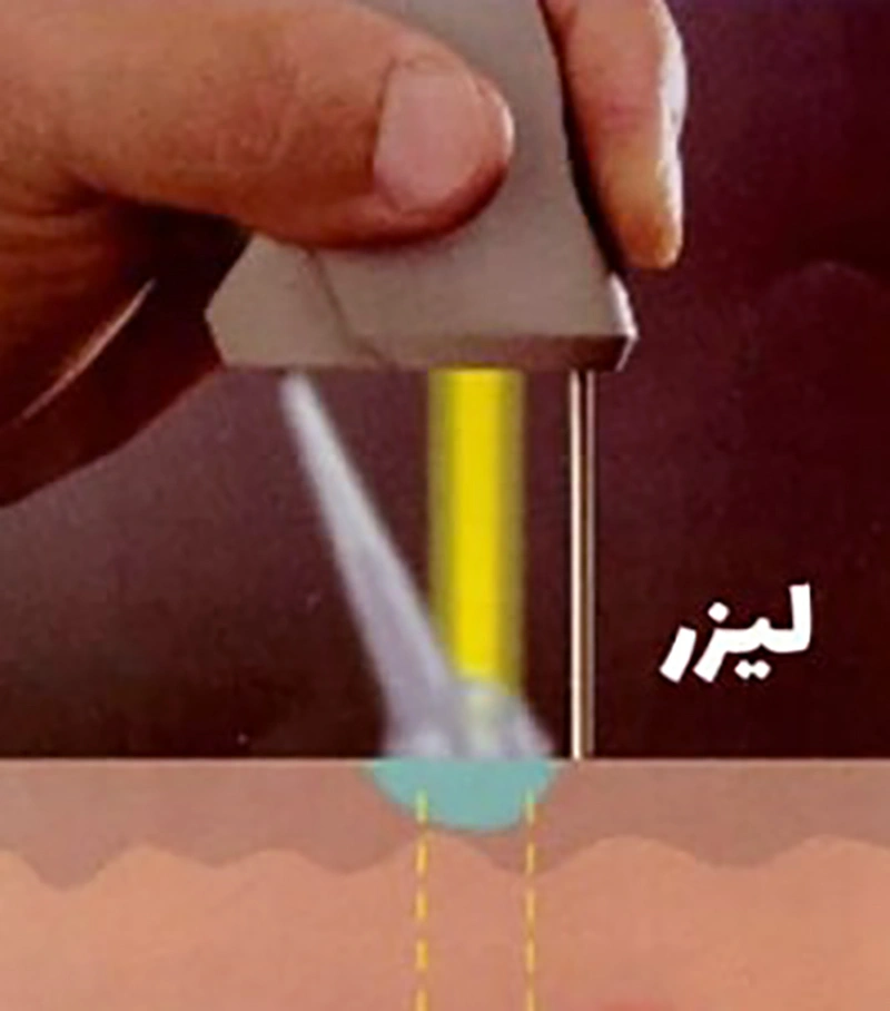 درمان زگیل تناسلی