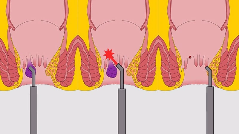 بهترین دکتر برای لیزر هموروئید در تهران کیست؟ | کلینیک درمان اول