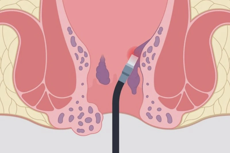 بهترین دکتر برای لیزر هموروئید در تهران کیست؟