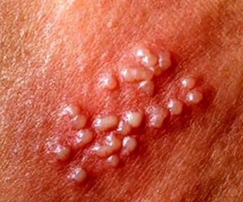 تفاوت تبخال با زگیل تناسلی چیست؟