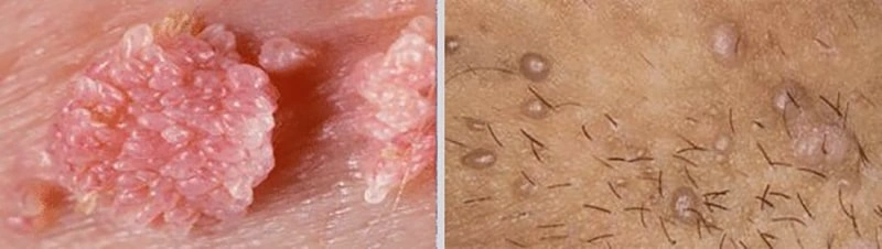 تفاوت زگیل تناسلی مردان و زنان