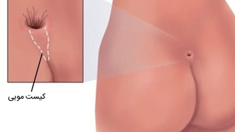 بهترین دکتر برای درمان کیست مویی در تهران کیست؟