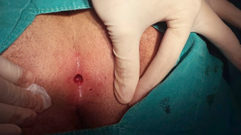 بهترین دکتر برای درمان کیست مویی در تهران کیست؟