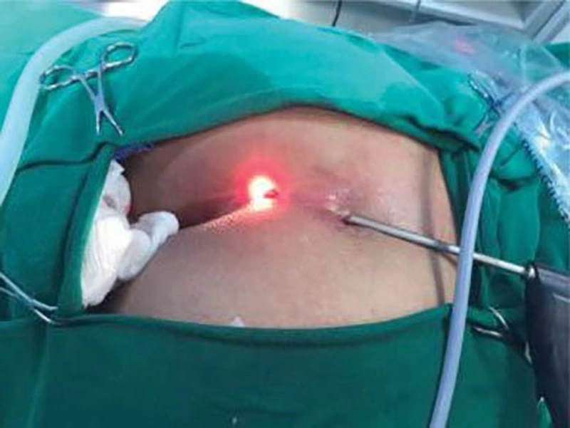 بهترین دکتر برای درمان کیست مویی در تهران کیست؟