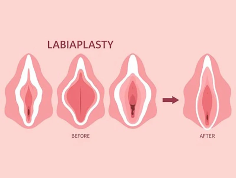مراقبت های لازم قبل و بعد از عمل لابیاپلاستی