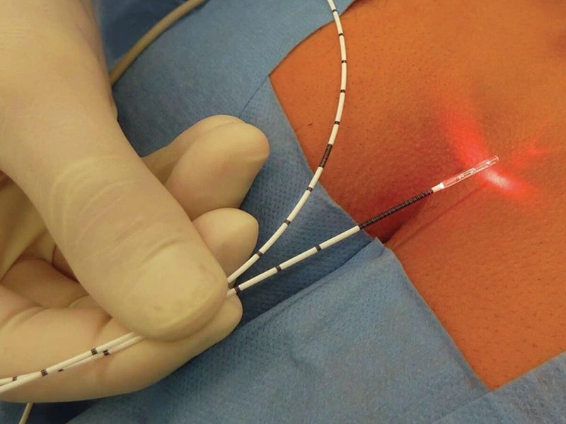 هزینه عمل شقاق با لیزر در تهران چقدر است؟