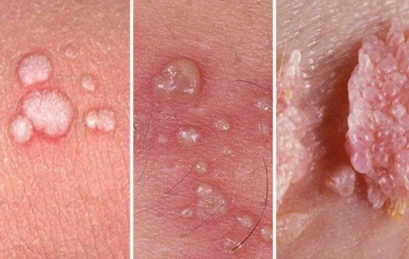 زگیل تناسلی چیست؟ علائم، علل، پیشگیری و درمان