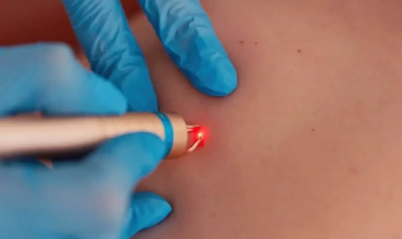 بعد از سوزاندن زگیل تناسلی چه باید کرد؟ | کلینیک درمان اول