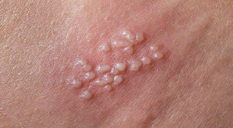 بعد از سوزاندن زگیل تناسلی چه باید کرد؟