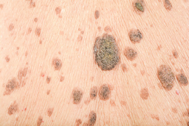   راه‌های انتقال ویروس HPV و پیشگیری از زگیل تناسلی کدام‌اند؟