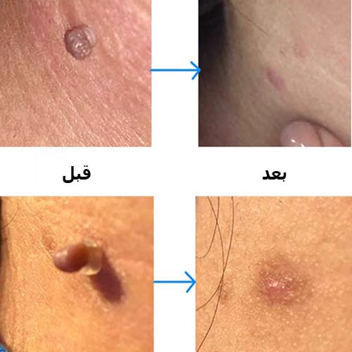 درمان زگیل تناسلی با کرایو