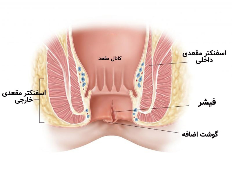 درمان شقاق با لیزر